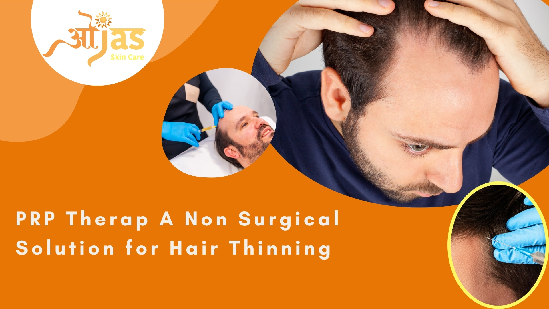 PRP Therap A Non Surgical Solution for Hair Thinning