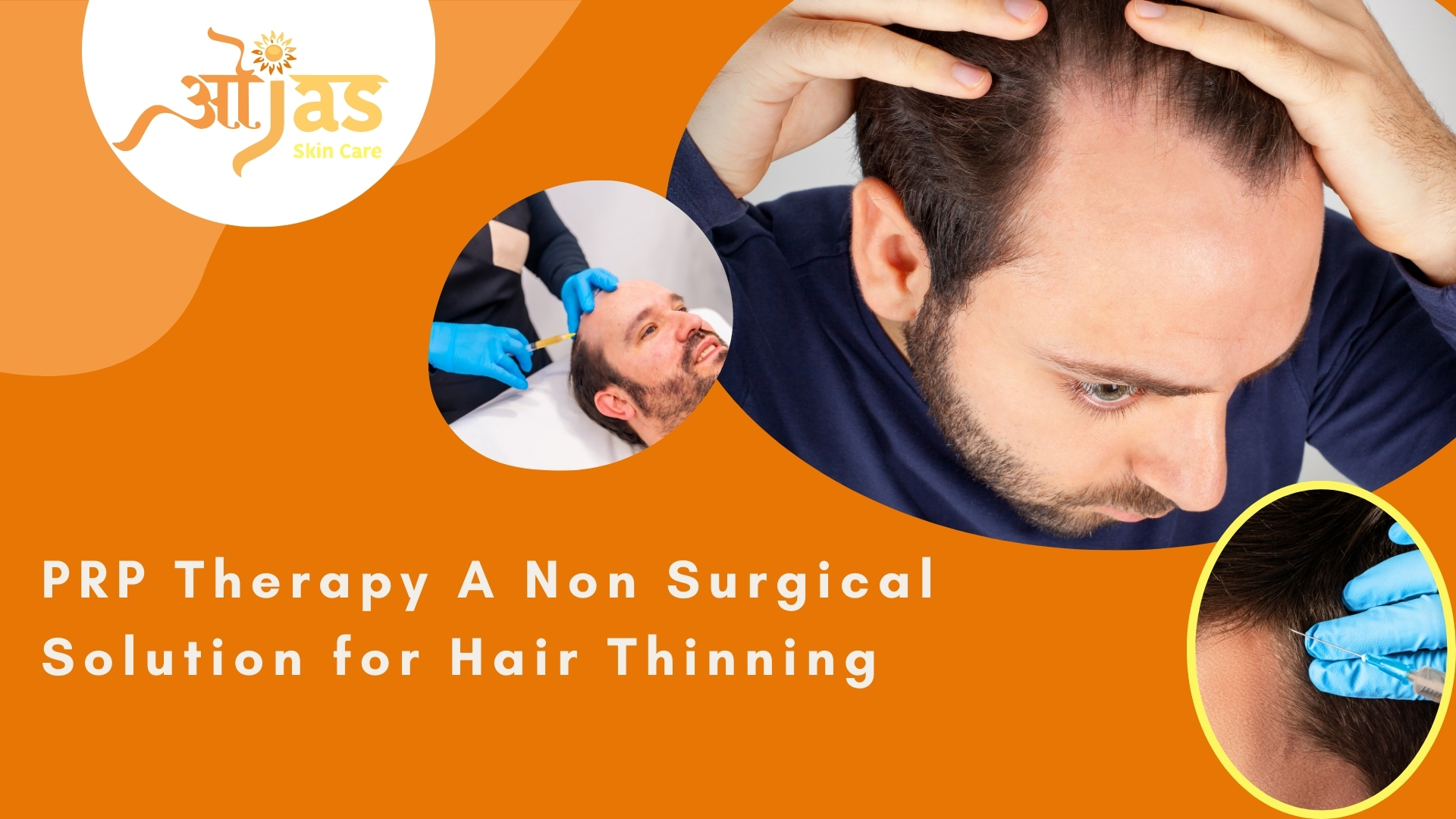 PRP Therapy A Non Surgical Solution for Hair Thinning
