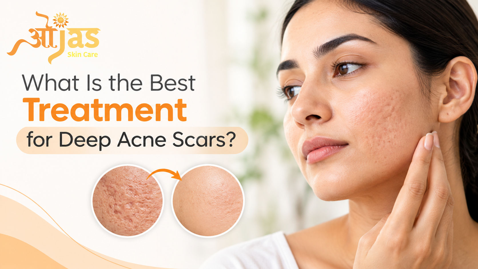 Best Deep Acne Scars Treatment in Noida